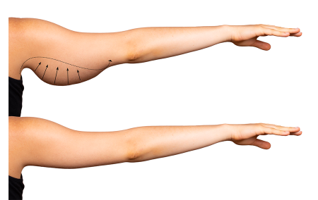 arm-lift-900x568